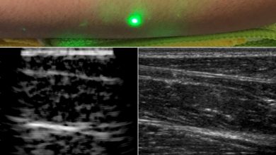 Photo of Researchers produce first laser ultrasound images of humans